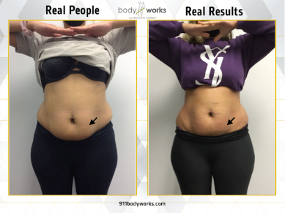 Body Works Ultra Lipo Clinic