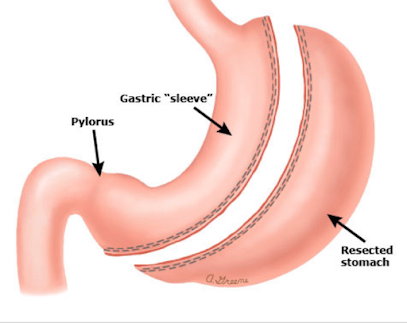 Arch Bariatrics: Kumaran Chinnappan, MD, FACS: Bariatric Weight Loss Surgery